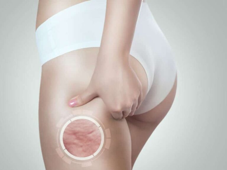 celulitis-y-varices:-el-metodo-de-la-medicina-tradicional-china-para-trabajar-las-piernas
